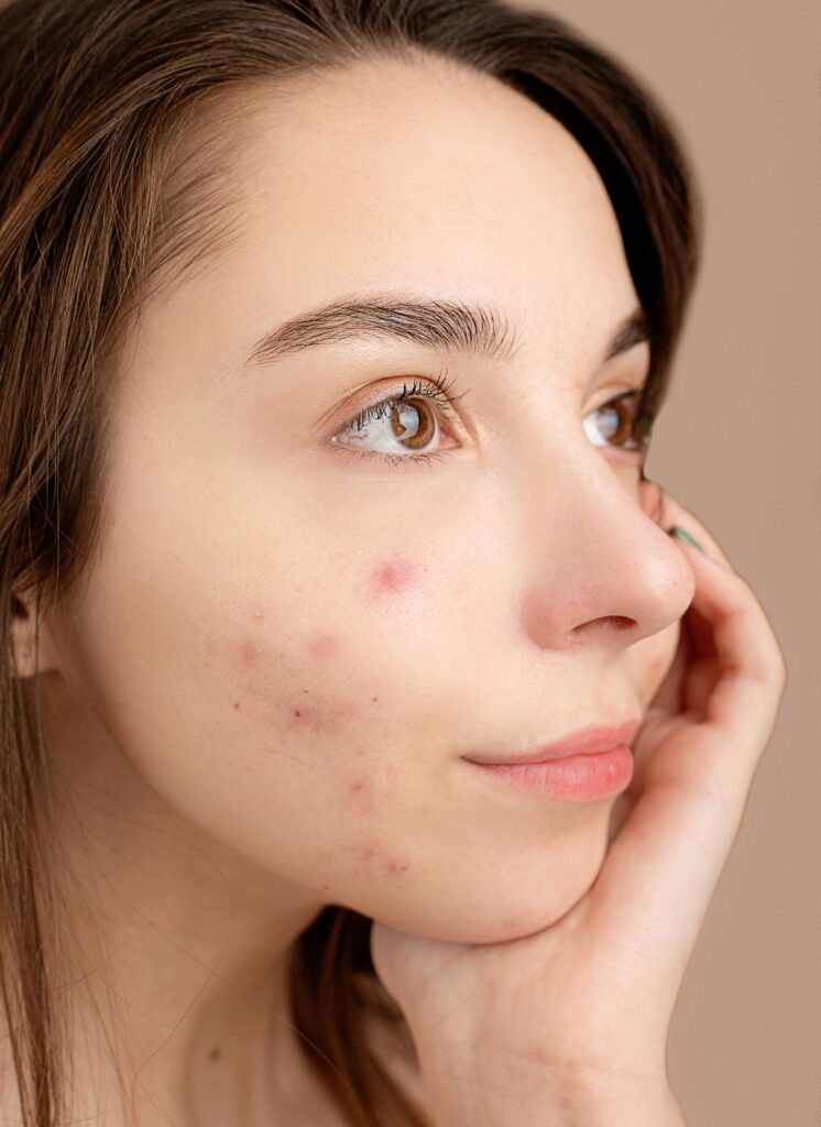 Close-up portrait of a young woman with acne, hand on face, pensive expression.
